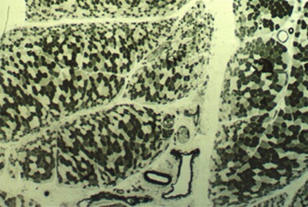 Dermatomyositis ATPase stain with perifascicular atrophy in Dermatomyositis