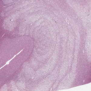 Balos Concentric Sclerosis Balos Concentric Sclerosis on brain biopsy