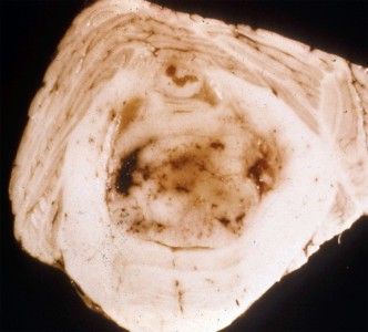Medulloblastoma Cerebellar Medulloblastoma gross pathology specimen