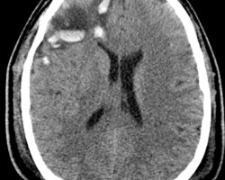 Cerebral Contusion Cerebral Contusion on CT head