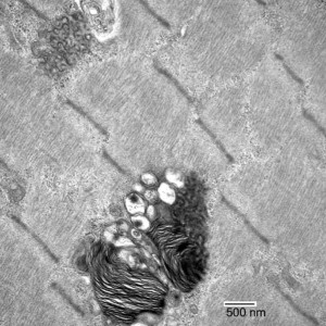 Chloroquine Myopathy Electron microscopy showing curvilinear inclusions in Chloroquine Myopathy