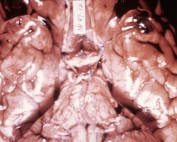 Contrecoup Contusion Contrecoup Contusion on gross neuropathology brain specimen