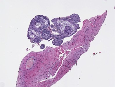 Craniopharyngioma Craniopharyngioma pathology specimen showing Encapsulated tumor with well differentiated nonkeratinizing squamous epithelium and papillary fibrovascular stroma