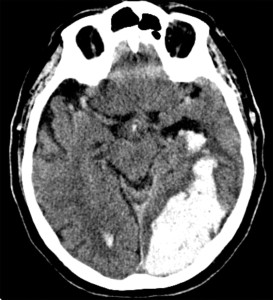 Intraparenchymal Hemorrhage with Uncal Herniation Intraparenchymal Hemorrhage with Uncal Herniation on CT head