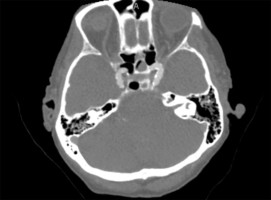 Basilar Occlusion on CTA