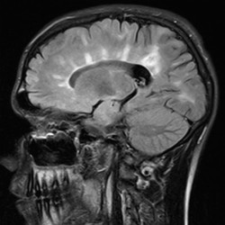 Dawson's Fingers in Multiple Sclerosis Multiple Sclerosis patient with Dawsons Fingers on MRI T2 flair