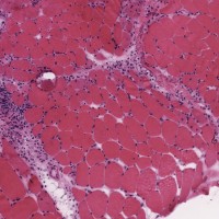 Dermatomyositis Dermatomyositis biopsy with perimysial inflammation and atrophy