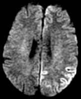 MRI of patient with Creutzfeldt-Jakob Disease showing cortical ribboning