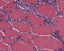 Polymyositis Polymyositis biopsy sample with endomysial inflammatory cells
