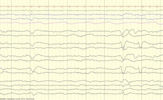 Frontal Sharps EEG review EEG tracing showing frontal sharps in neonate