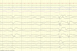 Frontal Sharps EEG review EEG tracing showing frontal sharps in neonate