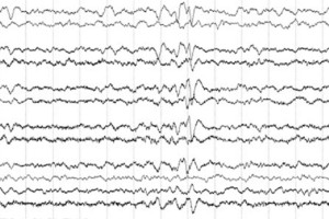 Frontal Sharps EEG review frontal sharps in neonate on EEG tracing