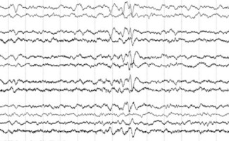 Frontal Sharps EEG review frontal sharps in neonate on EEG tracing