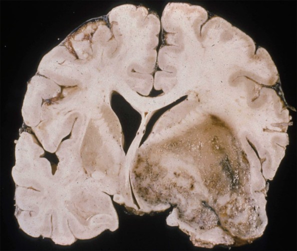 Glioblastoma Multiforme Glioblastoma Multiforme coronal gross brain section showing Large necrotic mass with increased vascularity and mass effect on the surrounding white matter