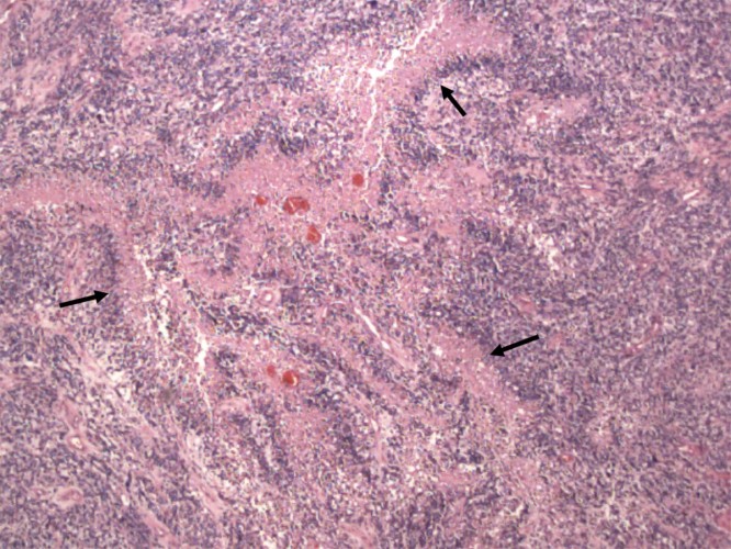 Glioblastoma Multiforme Glioblastoma Multiforme microscope slide Low-power view showing palisading, or pseudo-palisading, necrosis with a rim of viable tumor-cell nuclei lining up around a region of necrotic tumor