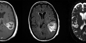 Glioblastoma Multiforme (GBM) Glioblastoma Multiforme (GBM) on axial MRI with contrast and T2 FLAIR