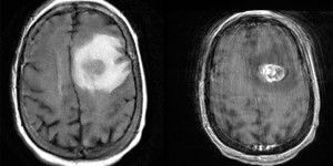 Glioblastoma Multiforme Glioblastoma Multiforme on axial MRI T2 and T2 with contrast