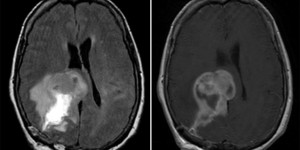 Glioblastoma Multiforme Glioblastoma Multiforme on axial brain MRI T2 FLAIR and T1 with contrast