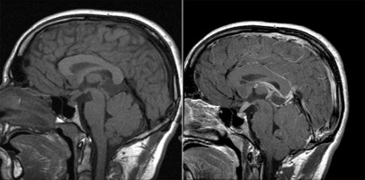 Germinoma on sagittal MRI T2 FLAIR and T1 with contrast