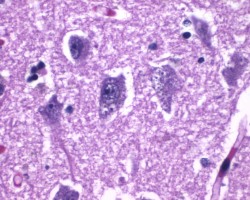 Granulovacuolar degeneration Granulovacuolar degeneration in Alzheimer's disease. Medium power H&E image showing intraneuronal accumulations of large vacuoles harboring a central granule.