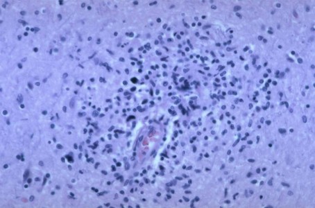 HIV Brain Biopsy Neuroinfectious disease HIV Brain Biopsy pathology slide with perivascular macrophages and multinucleate giant cells in white matter