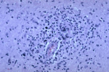 HIV Brain Biopsy Neuroinfectious disease HIV Brain Biopsy pathology slide with perivascular macrophages and multinucleate giant cells in white matter