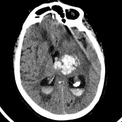 Intracerebral Hemorrhage of Left Thalamus Intracerebral Hemorrhage of Left Thalamus on CT head