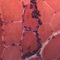 Inclusion Body Myositis Inclusion Body Myositis biopsy with lymphocyte invasion