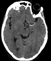 Left Hyperdense MCA Sign on axial head CT