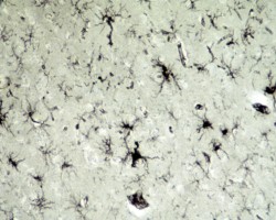 Alzheimer's Disease Alzheimer's Disease Tangles and plaques on lectin stain