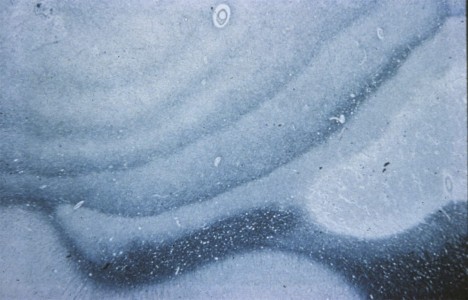 Balos Concentric Sclerosis, Multiple Sclerosis Variant Balos Concentric Sclerosis Multiple sclerosis Variant brain biopsy with luxol blue stain