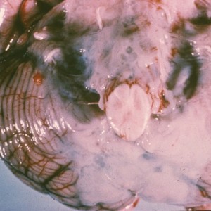 Bacterial Meningitis Abundant gray-white exudate surrounding the brainstem and cerebellum secondary to pneumococcal meningitis