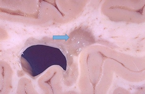 Multiple Sclerosis Plaque Multiple Sclerosis Plaque on gross brain specimen