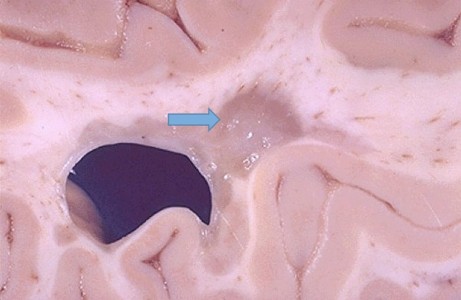 Multiple Sclerosis Plaque Multiple Sclerosis Plaque on gross brain specimen