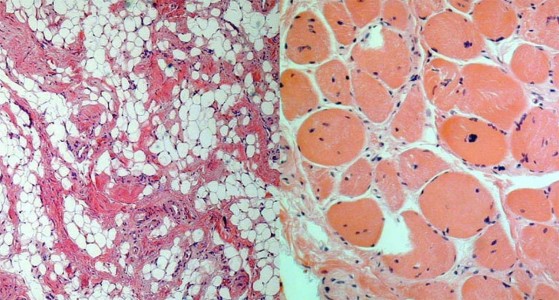 Myotonic Dystrophy Myotonic Dystrophy biopsy Specimen of muscle atrophy