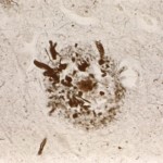 Neuritic Plaques Neuritic amyloid Plaques on silver stain slide