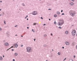 Alzheimer's Disease Alzheimer's Disease Neurofibrillary tangles on H&E stain