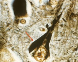 Alzheimer's Disease Alzheimer's Disease Neurofibrillary tangles on silver stain