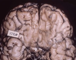 Old Inferior Frontal Lobe Contusions Old Inferior Frontal Lobe Contusions on gross brain pathology specimen