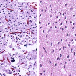 Oligodendroglioma Oligodendroglioma biopsy pathology slide with cells with the classic fried egg appearance
