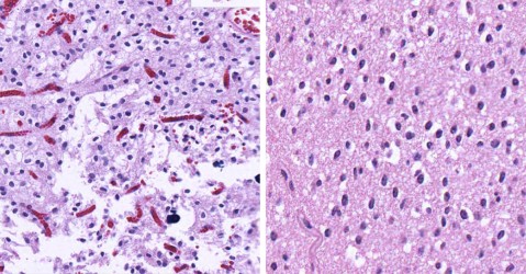 Oligodendroglioma Oligodendroglioma biopsy pathology slide with cells with the classic fried egg appearance