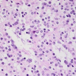 Oligodendroglioma Oligodendroglioma biopsy pathology slide with cells with the classic fried egg appearance