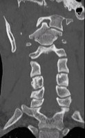 Odontoid Fracture on MRI cervical spine coronal view