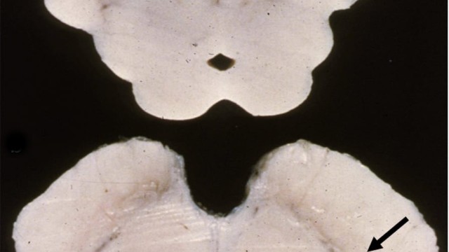 Parkinson's Disease Parkinsons Disease midbrain cross section with pale substantia nigra