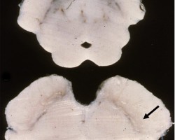 Parkinson's Disease Parkinsons Disease midbrain cross section with pale substantia nigra