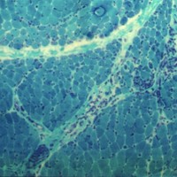 Dermatomyositis Dermatomyositis Trichrome stain with perifascicular atrophy