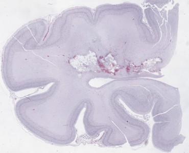 Periventricular Leukomalacia Periventricular Leukomalacia neuropathology slide of Very low power view poorly stained H&E with chalky white periventricular white matter lesions with necrosis
