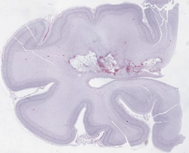 Periventricular Leukomalacia Periventricular Leukomalacia neuropathology slide of Very low power view poorly stained H&E with chalky white periventricular white matter lesions with necrosis