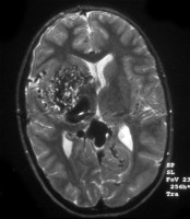 Right arteriovenous malformation (AVM) on MRI AVM