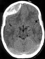 Epidural Hematoma on CT head